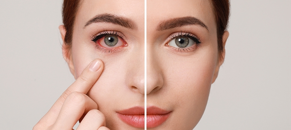 Göz kanlanması neden olur? Göz kanlanması neye işarettir?