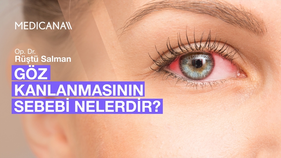 Göz Kanlanmasının Sebebi Nelerdir?
