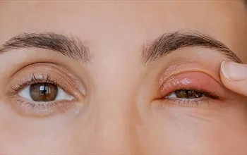Göz kapağı ağrısı neden olur? Göz kapağı ağrısı nasıl geçer?