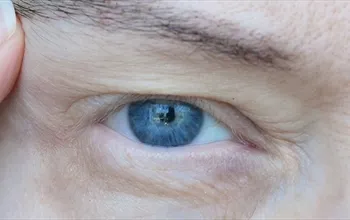 Göz kapağı düşüklüğü nasıl düzelir? Göz kapağı düşüklüğü ameliyatı ve ameliyatsız tedavi yöntemleri…