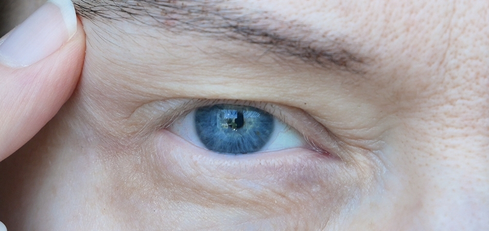 Göz kapağı düşüklüğü nasıl düzelir? Göz kapağı düşüklüğü ameliyatı ve ameliyatsız tedavi yöntemleri…