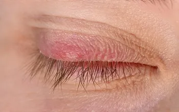 Göz kapağı iltihabı neden olur? Göz kapağı iltihabına ne iyi gelir?