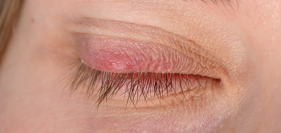 Göz kapağı iltihabı neden olur? Göz kapağı iltihabına ne iyi gelir?