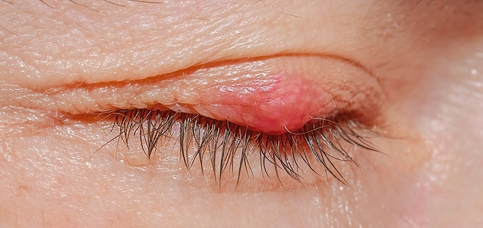 Göz kapağı şişmesi neden olur? Göz şişmesi neyin belirtisi olabilir?