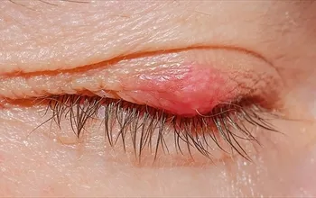 Göz kapağı şişmesi neden olur? Göz şişmesi neyin belirtisi olabilir?