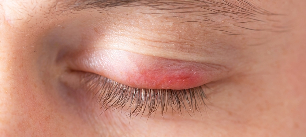 Göz kapağı şişliği neden olur? Göz kapağı şişmesi nasıl geçer?