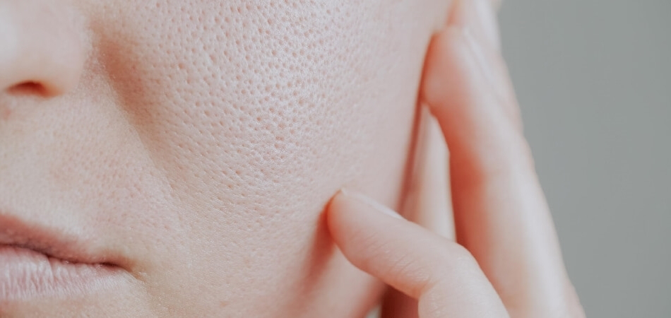 Gözenek küçültmek için ne yapılmalı? En etkili gözenek tedavisi nedir?