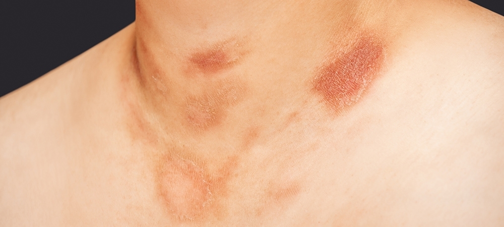 Gül hastalığı nedir? Gül hastalığının belirtileri nelerdir?