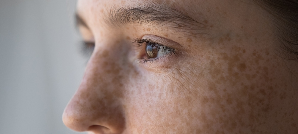 Güneş lekesi nedir? Güneş lekesi nasıl geçer?