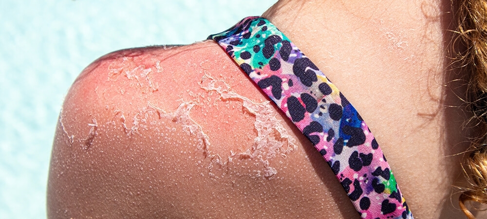 Güneş yanığı nedir? Güneş yanığı en çabuk nasıl geçer?