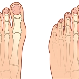 Halluks Valgus (Ayak Baş Parmağı Yamulması)