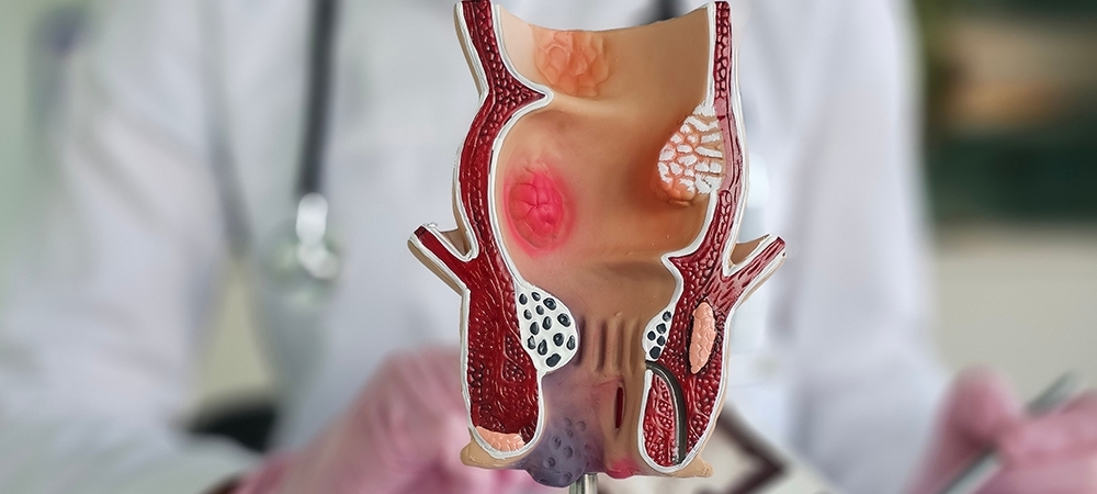 Hemoroid nedir? Hemoroid (basur) belirtileri ve tedavisi...