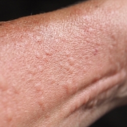 Histamin Alerjisi Nedir? Teşhis & Tedavi Süreci 