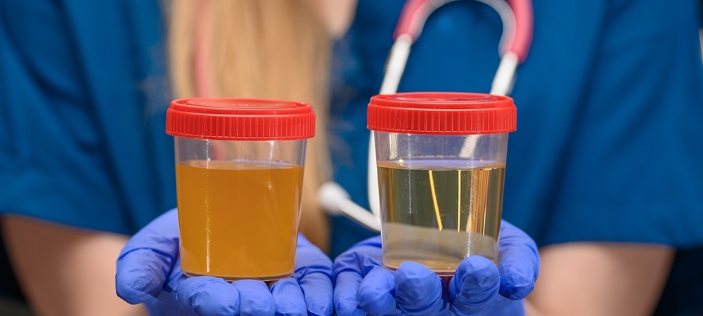 İdrar rengi ne anlama gelir? Hangi idrar rengi tehlikeli?