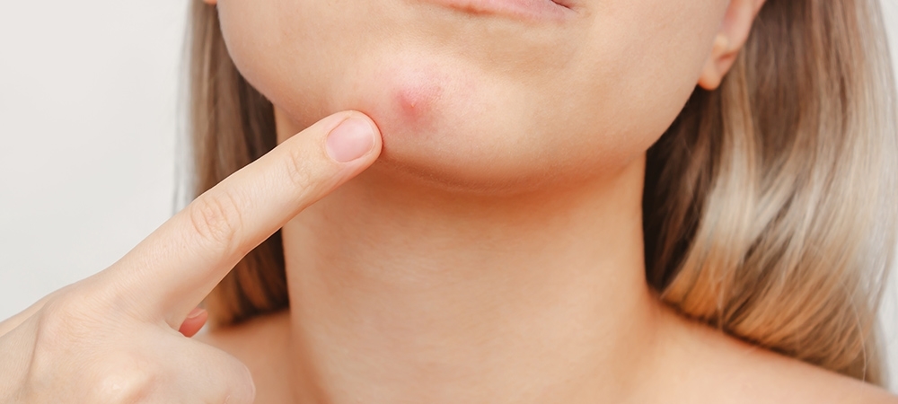 İltihaplı sivilce neden olur? İltihaplı sivilce nasıl geçer?