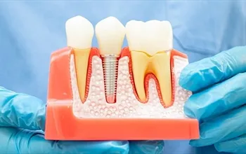 İmplant nedir? İmplant tedavisinin faydaları ve riskleri nelerdir?