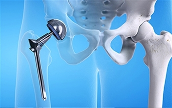 Kalça Protezi Yaşamı Kolaylaştırıyor!