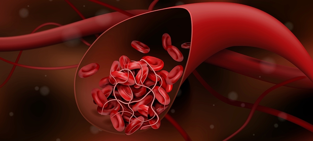 Kan pıhtılaşması (tromboz) nedir? Kan pıhtılaşmasına ne iyi gelir?