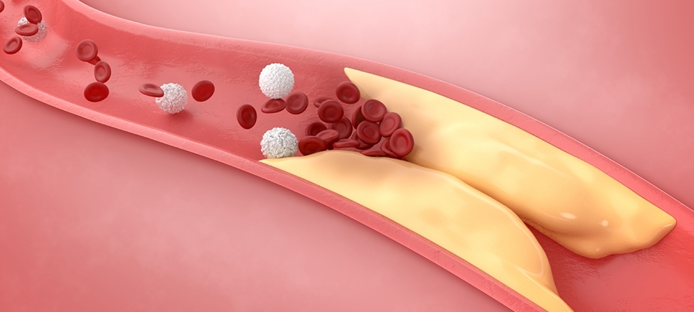 Kandaki yağı eriten bitkiler neler? Kandaki yağı eritmek için ne yapmalı?