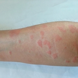 Kelebek Hastalığı (Epidermolizis Bülloza)