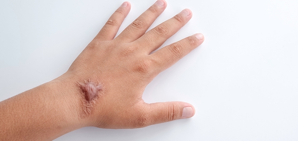 Keloid nedir? Keloid nasıl geçer?