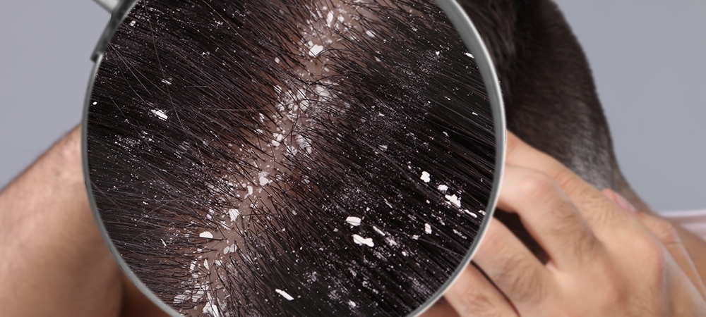 Kepeğe ne İyi gelir? Kepek nasıl geçer?