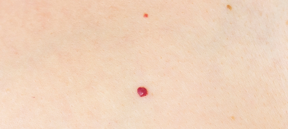 Kırmızı ben neden olur? Kırmızı et beni tehlikeli midir?