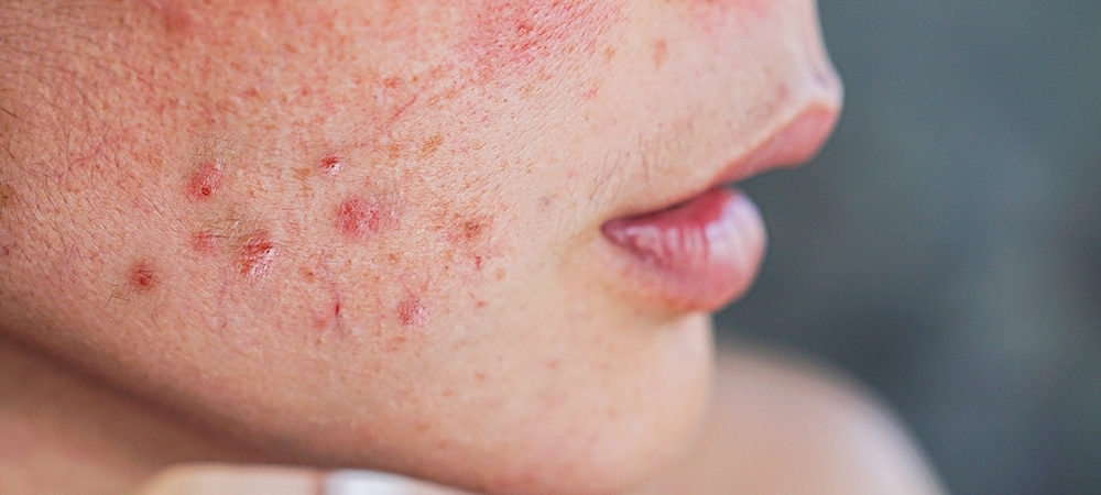 Kırmızı sivilce lekeleri nasıl geçer? Kırmızı sivilce izleri kalıcı mı?