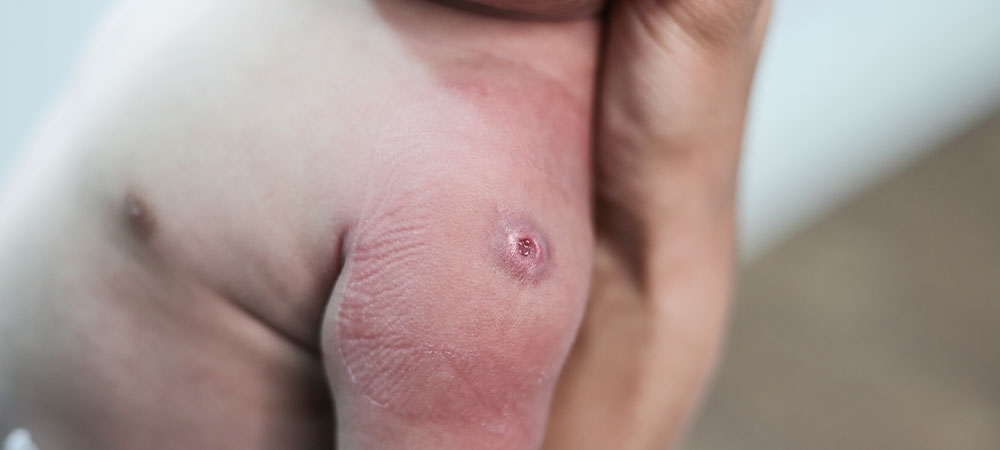 Kızamıkçık belirtileri nelerdir? Kızamıkçık ile kızamık arasındaki fark nedir?