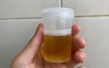 İdrarda neden köpük olur?