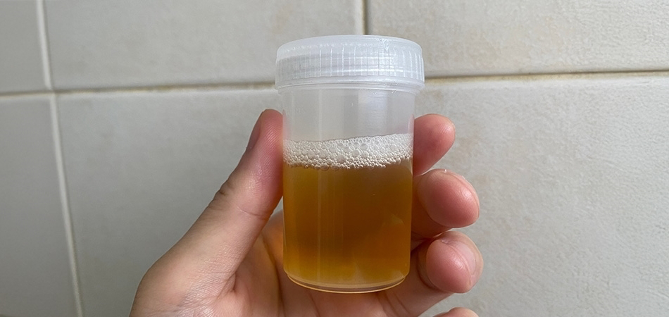 İdrarda neden köpük olur?