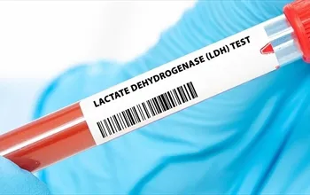 Laktat dehidrogenaz (LDH): Doku hasarının evrensel belirteci