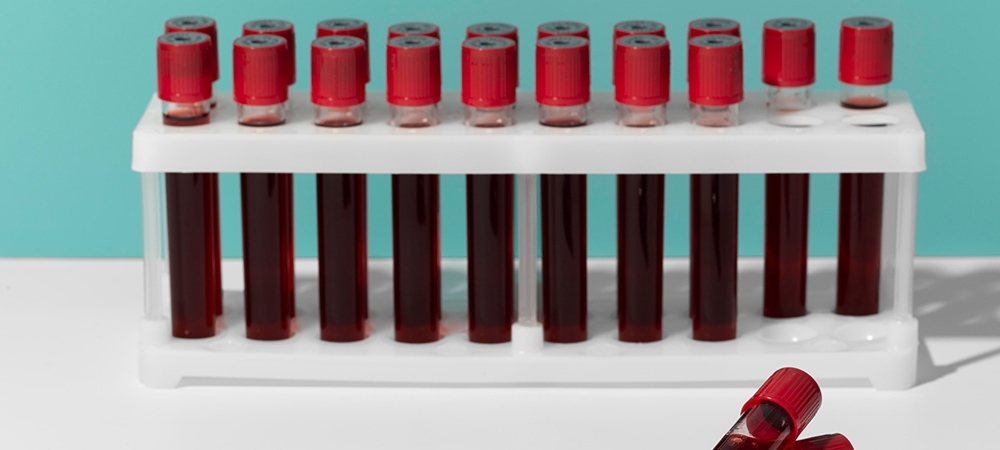 LDH yüksekliği ne anlama gelir? LDH yüksek çıkarsa ne olur?