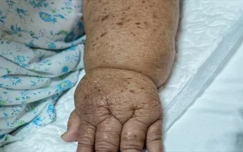 Lenfödemi olan kişiler egzersiz yapabilir mi? Güvenli egzersiz ilkeleri