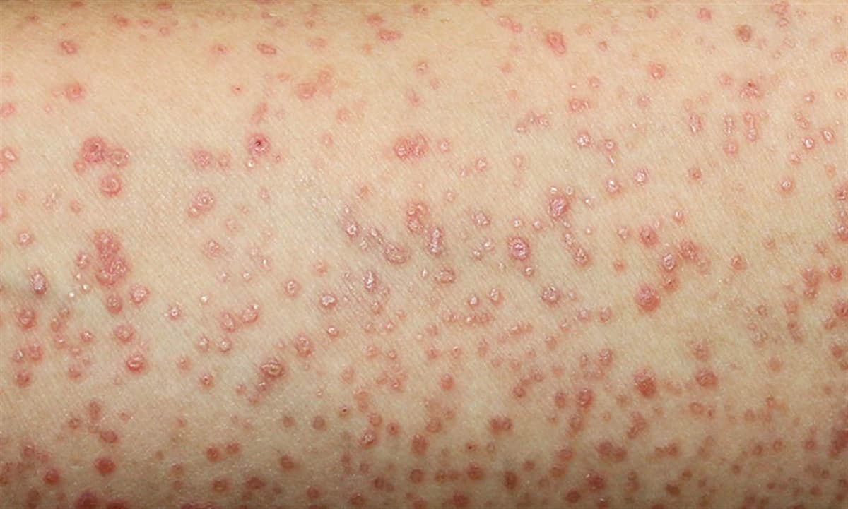 Liken Planus Nedir? Belirtileri ve Tedavi Yöntemleri Nelerdir?