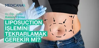 Liposuction İşlemini Tekrarlamak Gerekir mi?