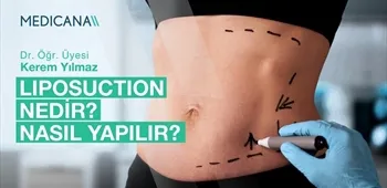 Liposuction Nedir? Nasıl Yapılır?