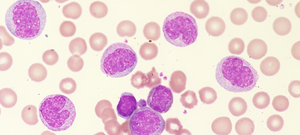 Lökosit ne demektir? Lökositin normal değeri kaç olmalı?