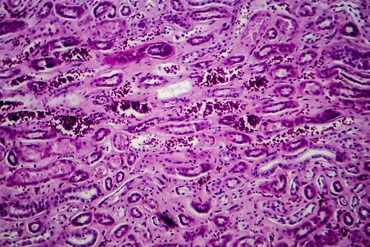 Lupus Nefriti