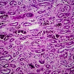 Lupus Nefriti