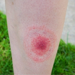 Lyme Hastalığı Nedir? Belirtileri & Tedavisi