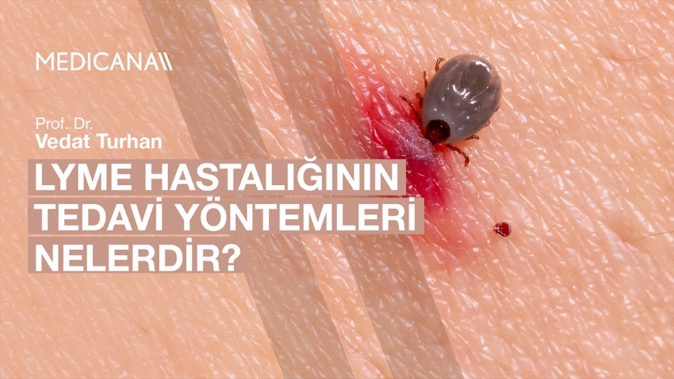 Lyme Hastalığının Tedavi Yöntemleri Nelerdir?