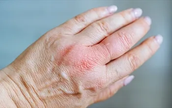 Makrodaktili ne demek? Makrodaktili neden olur?