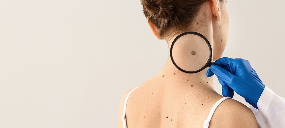 Malign melanom nedir? Malign melanom en sık nerede görülür?