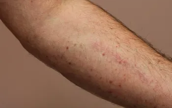 Mastositoz nedir? Mastositoz lekeleri nasıl geçer?