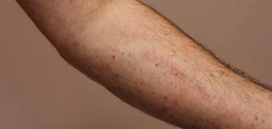 Mastositoz nedir? Mastositoz lekeleri nasıl geçer?