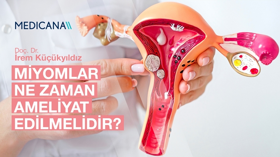 Miyomlar Ne Zaman Ameliyat Edilmelidir?