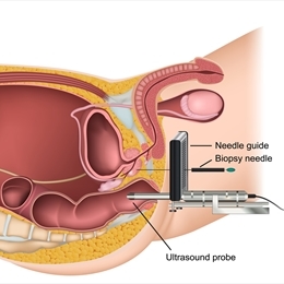 MR-TRUS Füzyon Prostat Biyopsisi