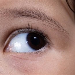 Nistagmus