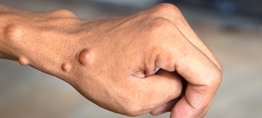 Nörofibromatozis nedir? Nörofibromatozis belirtileri nelerdir?